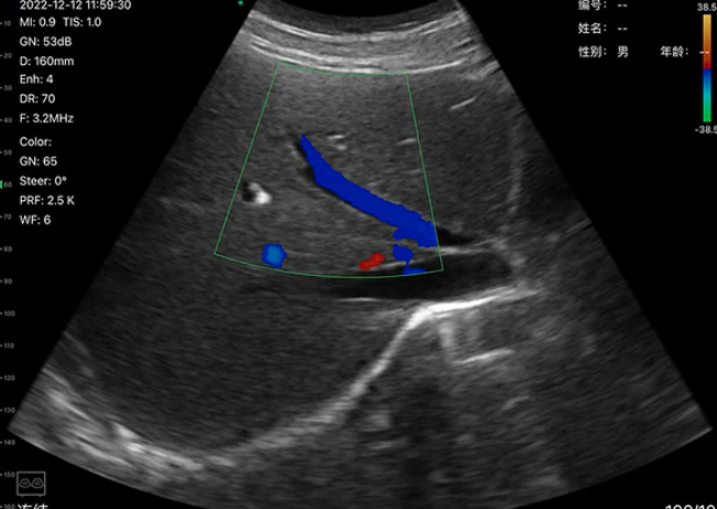 Sonde abdominale